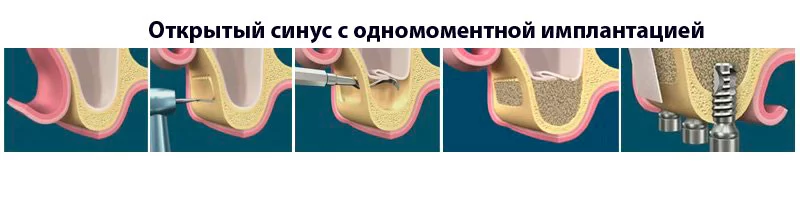 Открытый синус с одномоментной имплантацией