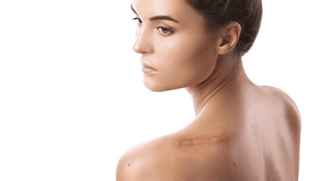 Коррекция рубцов на аппарате Ellipse MultiFlex